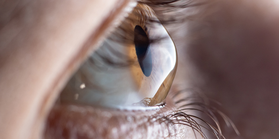 Keratoconus corneal condition
